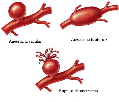 Aneurisma
