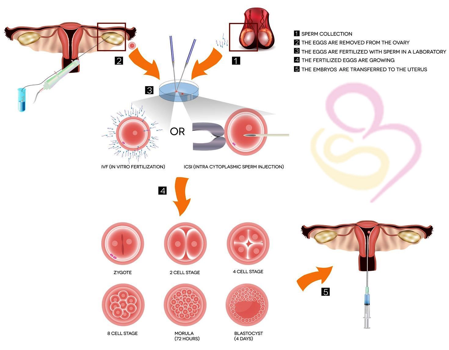 Test Tube baby center in Hyderabad India - SWCIC
