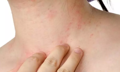 Eczema thể viêm da tiếp xúc