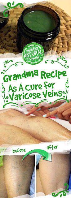 Grandma Recipe As A Cure For Varicose Veins