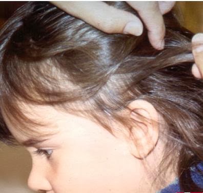 Eliminar el mejor para los casero piojos remedio