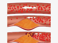Cara Menjaga Kolesterol Tubuh Agar Tetap Stabil