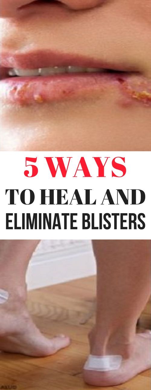 5 Ways To Heal And Eliminate Blisters Health Diy Blog