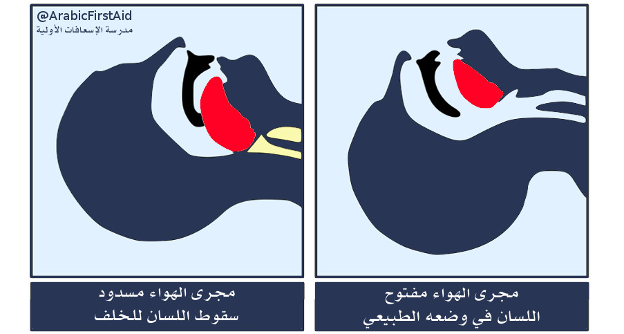بلع-اللسان-falling-back-of-the tongue