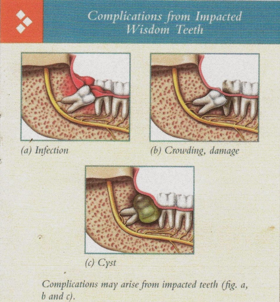 Ubat Gusi Geraham Bengkak Serial Serials