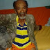 Idoso de 68 anos de Ruy Barbosa precisa de uma prótese após ter a perna direita amputada