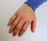 Spongiotic dermatitis is an acute eczema that often has a ...