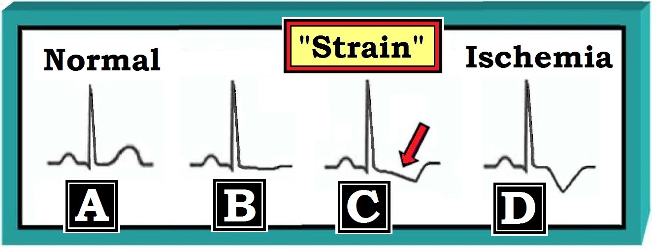Strain Pattern In Ecg