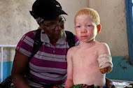 A triste história dos albinos da Tanzânia.