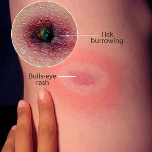 tick bite pictures on humans
