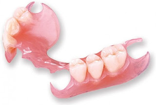 Trồng răng nguyên hàm dạng tháo lắp