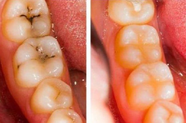 Incredible Home Remedies to Heal Cavities and Tooth Decay Naturally