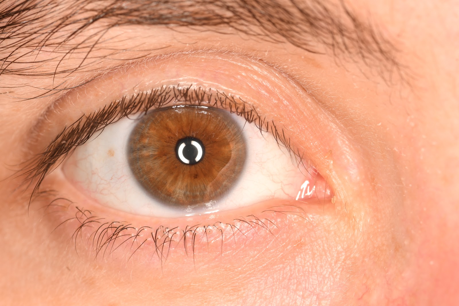 The story of my eye Before [cataract surgery] photos