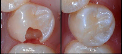 Nên biết quy trình trám răng diễn ra như thế nào?