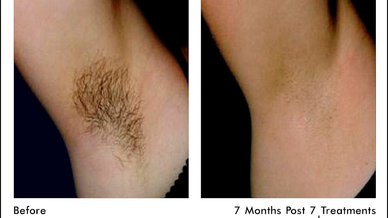 Laser Hair Removal Effectiveness - Effect Choices