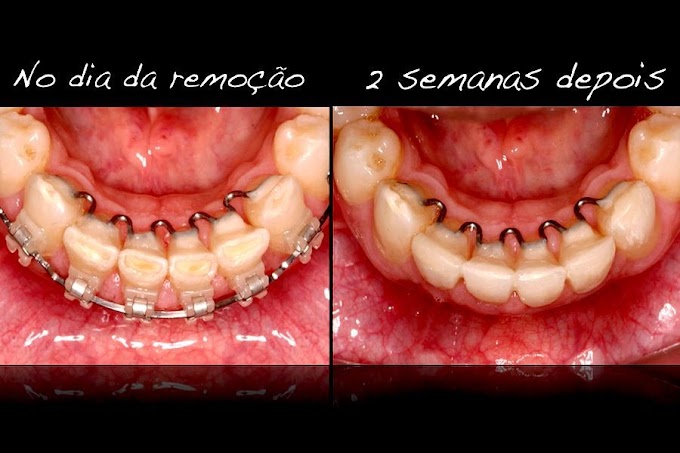 Interrelação Ortodontia-Dentística (Prof. Rafael Bicalho)