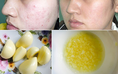 Trị Mụn Bằng Tỏi Tri Mun Bang Toi