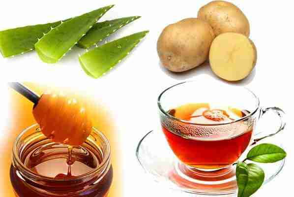 6 Cara Alami Mengatasi Luka Bakar Dengan Cepat
