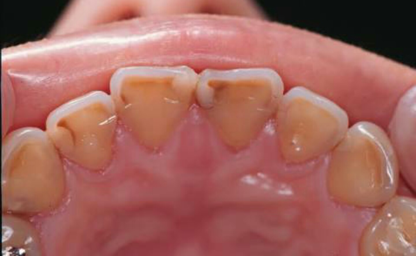 Images of 咬耗症 JapaneseClass.jp