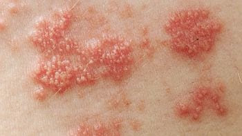 Suplemen Alami Yang Melawan Penyakit Herpes