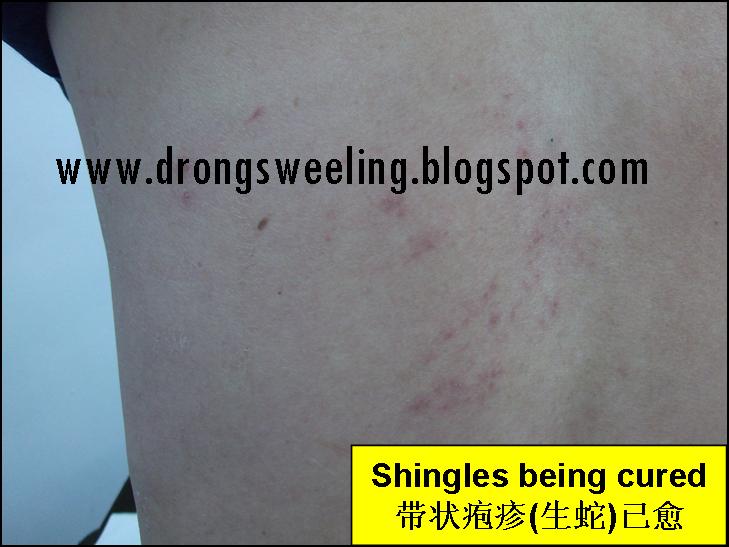 TCM News Best TCM Doctor for Shingles, Herpes Zoster, Postherpetic Neuralgia
