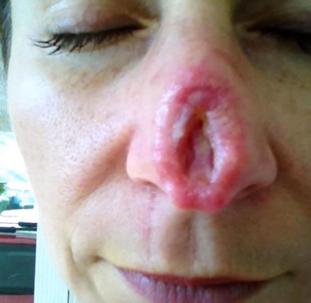 Woman left with massive hole in her nose after using herbal treatment