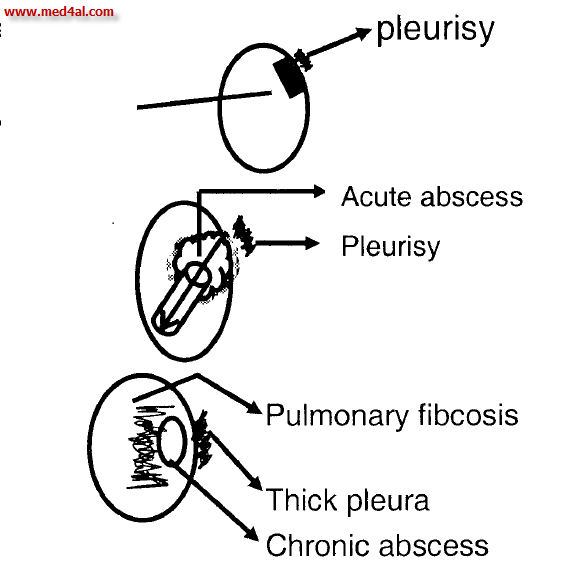 pathology of lung abscess