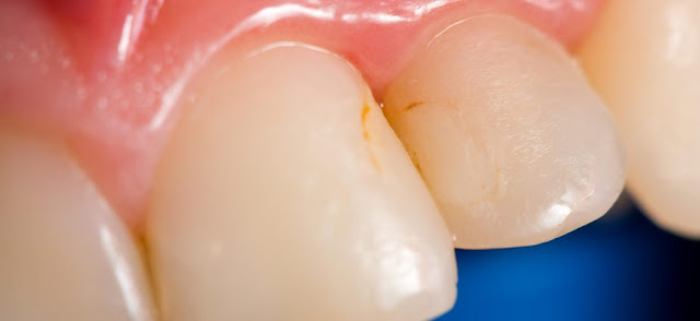 dents jaunes Causes