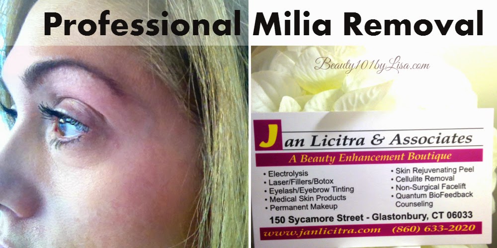 Quinnipiac University Transfer Laser Treatment For Milia