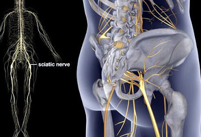 pain relief for sciatic