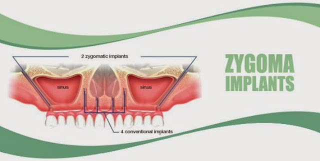  zygomatic dental implants