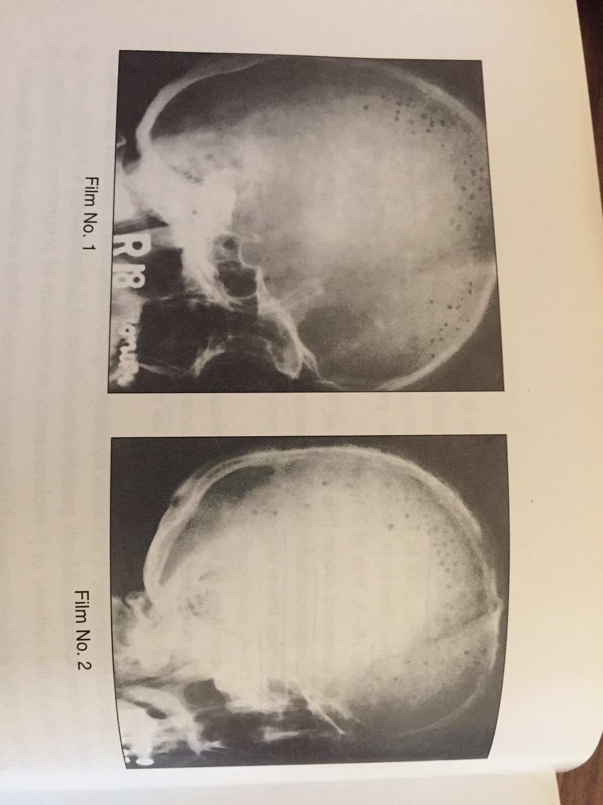 XRAYS OF HYPERPARATHYROIDISM