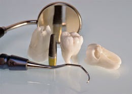 Les implants dentaires sont en sécurité