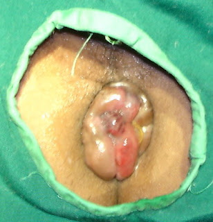 penyakit wasir