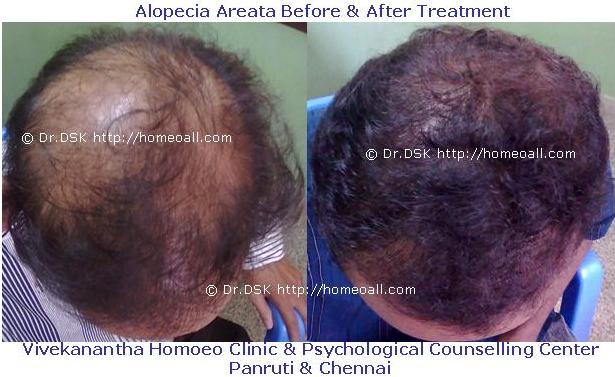  एलोपेस अरेटा - चेन्नई में बालों के झड़ने होम्योपैथी उपचार 