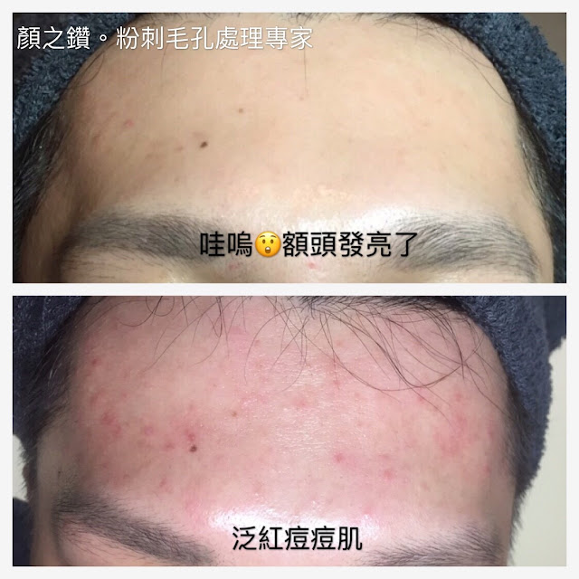 顏之鑽高雄美容做臉清粉刺除痘痘護膚SPA,奎蒂絲杏仁酸精華液, 高雄左營岩盤浴推薦, 高雄全身去角質推薦, 高雄美容沙龍推薦, 高雄美容SPA推薦, 高雄做臉清粉刺推薦, 高雄WAXXXX熱蠟除毛推薦, 顏之鑽高雄美容做臉清粉刺除痘痘護膚SPA,高雄左營美容店,左營美容SPA護膚, 高雄左營做臉,高雄左營做臉推薦,高雄左營做臉分享,高雄左營做臉評價,高雄左營做臉價格, 高雄左營清粉刺,高雄左營清粉刺推薦,高雄左營清粉刺店家,高雄左營清粉刺推薦店家,高雄左營清粉刺價格, 高雄左營清粉刺評價,高雄左營清粉刺分享,高雄左營清粉刺便宜,高雄左營無痛清粉刺,高雄左營擠粉刺, 高雄左營美顏店推薦,高雄左營美顏店家, 高雄左營美容店推薦, 高雄左營熱蠟除毛,高雄左營熱蠟除毛便宜,高雄左營熱蠟除毛分享,高雄左營熱蠟除毛評價,高雄左營熱蠟除毛價格, 高雄左營熱蠟除毛推薦,高雄左營蜜蠟除毛評價,高雄左營蜜蠟除毛便宜,高雄左營蜜蠟除毛價格,高雄左營蜜蠟除毛推薦, 高雄左營腋下除毛評價,高雄左營腋下除毛推薦,高雄左營腋下除毛價格,高雄左營腋下除毛分享,高雄左營腋下除毛便宜, 高雄左營私密處除毛評價,高雄左營私密處除毛推薦,高雄左營私密處除毛價格,高雄左營私密處除毛便宜, 高雄左營岩盤浴SPA,高雄左營岩盤浴,高雄左營岩盤浴推薦,岩盤浴高雄左營