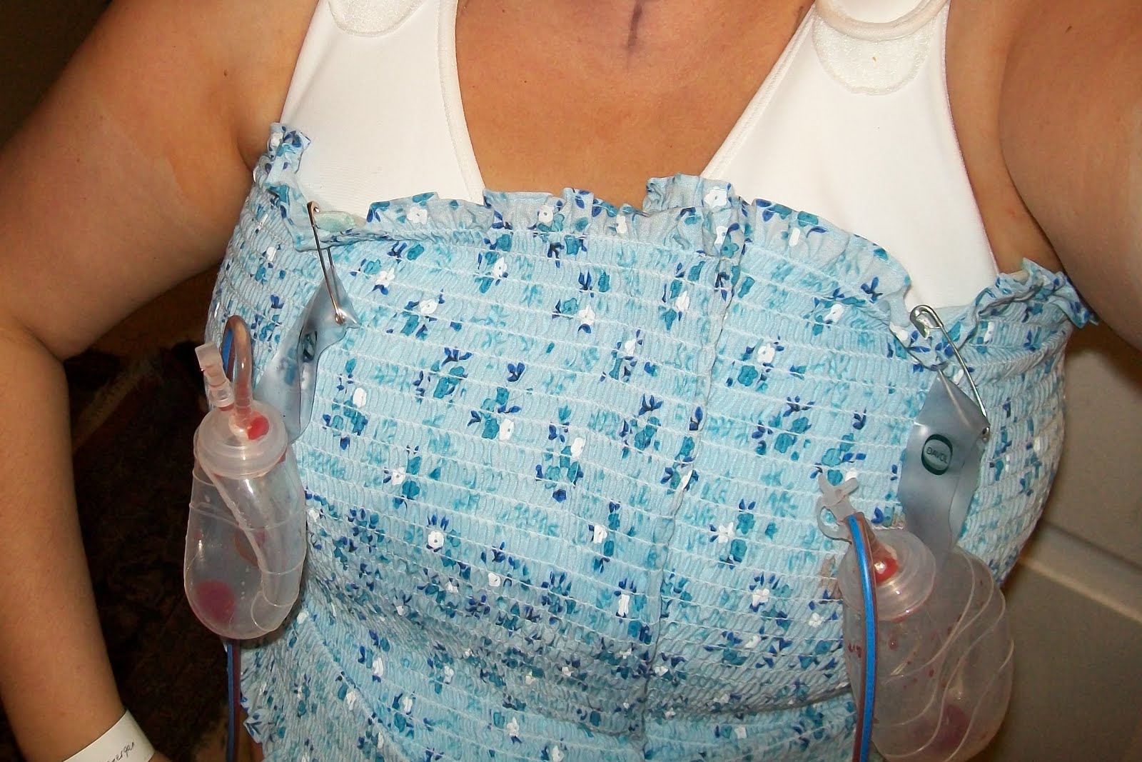 Don't Call Me Kath! Breast Reduction surgery