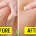 Powerful 3-Ingredient Mixture Will Help You Get Rid of Cellulite, Varicose Veins, Stretch Marks and Muscle Ache