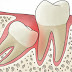 Tìm hiểu tác hại của răng khôn mọc ngầm