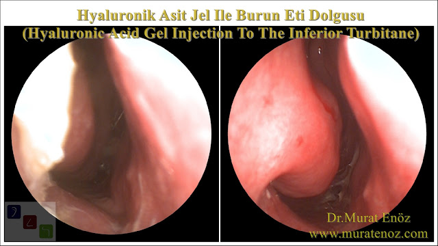 Boş burun sendromu tedavisinde Hyaluronik Asit dolgusu - Burun eti dolgusu - Treatment of Empty nose syndrome with hyaluronic acid filler - Boş burun - Geniş burun boşluğu sendromu - Burun eti büyütülmesi - Empty Nose Syndrome (ENS) - Hyaluronic acid gel in the treatment of empty nose syndrome - Empty Nose Syndrome - Treatment of Empty Nose Syndrome - Treatment of Empty Nose Syndrome in Istanbul