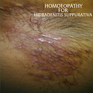 Homeopathy for HIDRADENITIS SUPPURATIVA