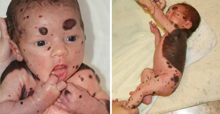 A Baby Is Born With Black Dots On His Back, The Doctors Revealed To His Mother What She Feared The Most