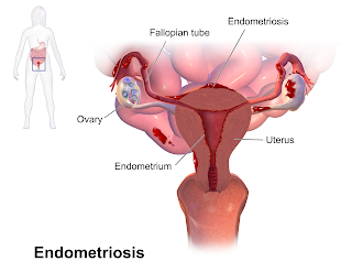 Obat Alami Penyakit Endometriosis