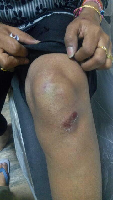 Anu Jain, a Delhi High Court advocate was brutally beaten with iron rods. 