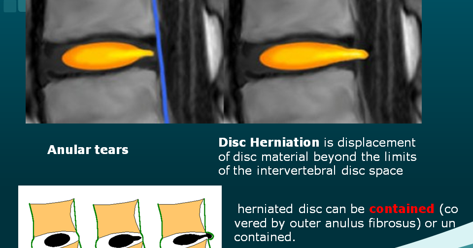 Musculoskeletal Annular Tear Annular Fissure