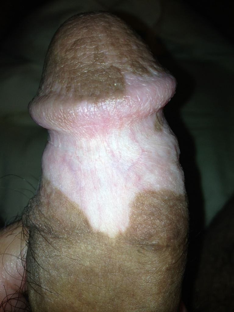 The Horror Of Penile Psoriasis (And What To Do About It!)