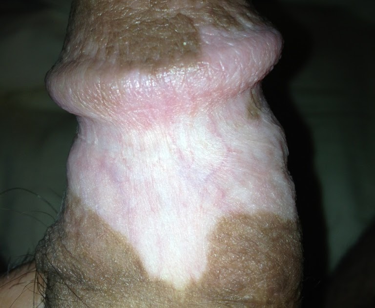 Vitiligo Of Penis 73