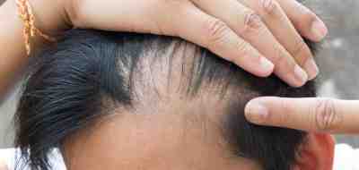 خلطات لنمو الشعر في مقدمة الراس