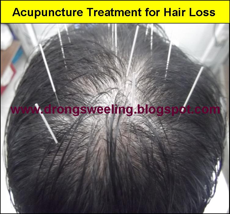 TCM News: Hair Loss and Bald Patches Chinese TCM Clinic