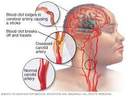 Nama Obat Untuk Stroke Murah dan Berkualitas, apa nama obat ampuh stroke berat?, Bagaimana Tips Herbal Mengobati Penyakit Stroke Ringan?